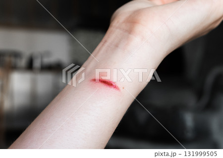 A close-up of a pale arm with a fresh burn mark. The skin shows a red line indicating injury. The background is blurred. 131999505