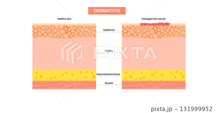 Dermatitis skin disease 131999952