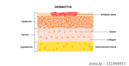 Dermatitis skin disease 131999953