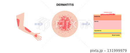 Dermatitis skin disease 131999979