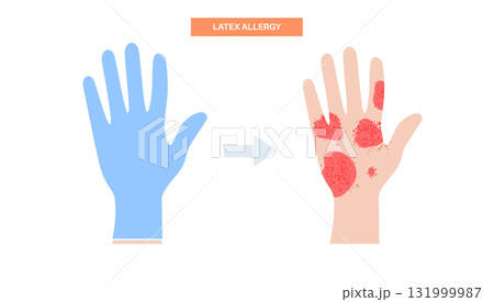 Latex allergy inflammation 131999987