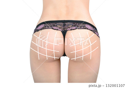 Marking arrow on the buttocks of women before surgery 132001107