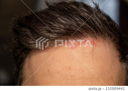 Scalp features visible patches of red, itchy skin related to psoriasis, highlighting the impact of this genetic immune disease on appearance. 132009442