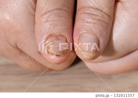 Cancer chemotherapy cause nails brittle or flaky. 132011357