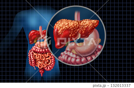 Fatty Liver Disease Fatty Liver Disease 132013337