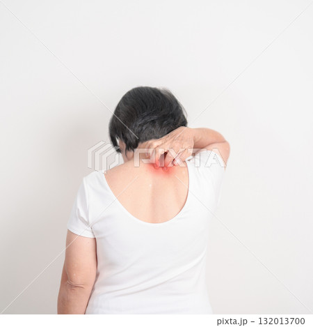 Elderly woman itching Neck and body scratching for Skin Allergy from insect bite and food dermatitis. Dermatology, Leprosy day, Systemic lupus erythematosus, Psoriasis, Urticaria and rash Eczema Elderly woman itching Neck and body scratching for Skin Allergy from insect bite and food dermatitis. Dermatology, Leprosy day, Systemic lupus erythematosus, Psoriasis, Urticaria and rash Eczema 132013700