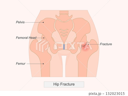 Showing a hip fracture a break in the upper femur near the hip joint. Showing a hip fracture a break in the upper femur near the hip joint. 132023015