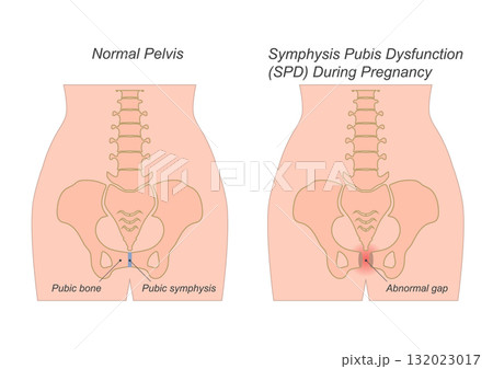 Symphysis Pubis Dysfunction in pregnancy, commonly occurring in the second or third trimester. 132023017