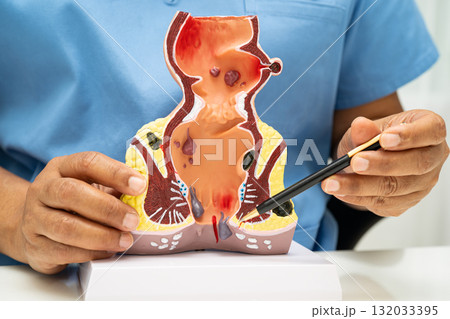 Asian doctor with rectum and hemorrhoid human anatomy model at hospital, inflamed vascular structure. Asian doctor with rectum and hemorrhoid human anatomy model at hospital, inflamed vascular structure. 132033395
