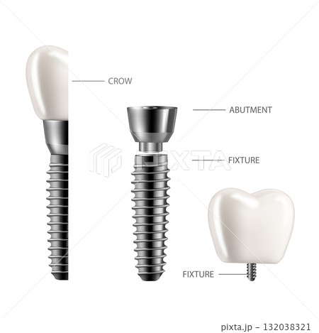 Dental implant structure infographic. Realistic 3D illustration with labeled components on white background for medical and educational use. 132038321