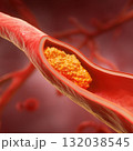3D medical illustration of artery with cholesterol plaque 132038545