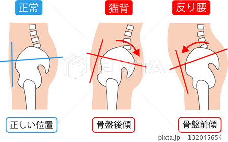 正しい骨盤の位置と骨盤後傾と骨盤前傾 132045654