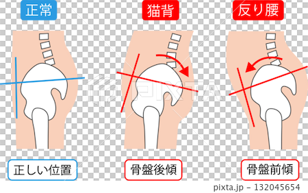 正しい骨盤の位置と骨盤後傾と骨盤前傾 132045654