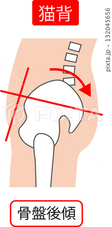 猫背　骨盤後傾 132045656
