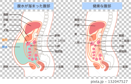 腹水腹部和健康腹部 腹水腹部和健康腹部 132047527