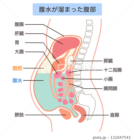 腹水が溜まった腹部 132047543