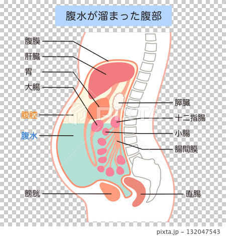 Abdomen with ascites 132047543