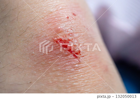 wound on child knee after fall on the ground 132050013
