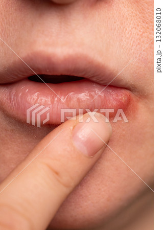Close up View of a Lip With Herpes Simplex Virus Lesion Close up View of a Lip With Herpes Simplex Virus Lesion 132068010