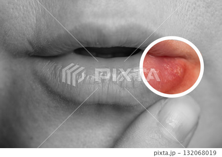 Close up of Lip Affected by Herpes Simplex Virus Infection 132068019