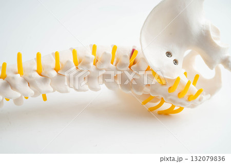 Spinal nerve and bone, Lumbar spine displaced herniated disc fragment, Model for treatment medical in the orthopedic department. 132079836
