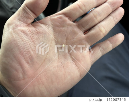 口から出た臭い匂いの膿栓 132087546