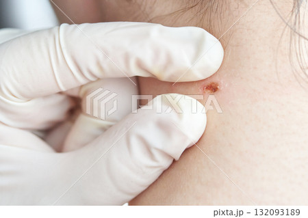 Caucasian adult skin examination by gloved hands checking mole on neck 132093189