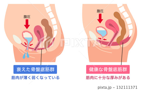 衰えた骨盤底筋群と健康な骨盤底筋群 衰えた骨盤底筋群と健康な骨盤底筋群 132111371