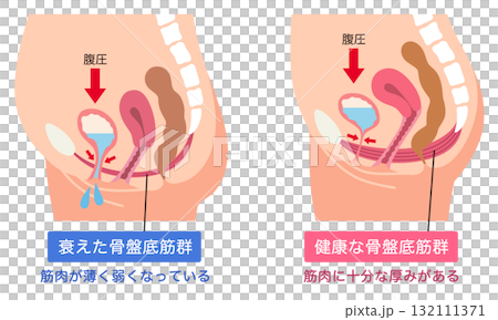 衰えた骨盤底筋群と健康な骨盤底筋群 衰えた骨盤底筋群と健康な骨盤底筋群 132111371
