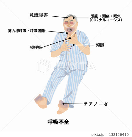 呼吸不全　チアノーゼと呼吸困難の患者 132136410