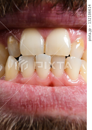 Close-up of adult teeth and gums. Close-up of adult teeth and gums. 132186614