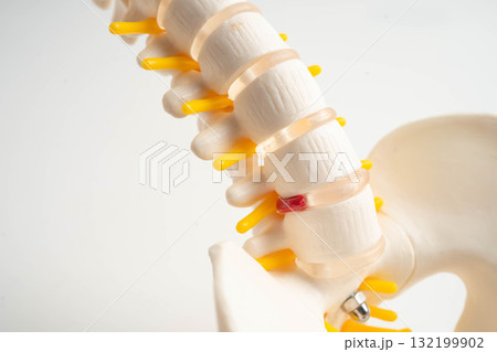 Spinal nerve and bone, Lumbar spine displaced herniated disc fragment, Model for treatment medical in the orthopedic department. 132199902