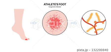 Athletes foot inflammation Athletes foot inflammation 132200840