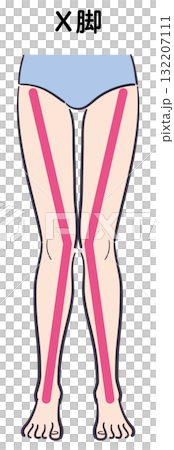 Illustration of X-legs (with auxiliary lines) 132207111