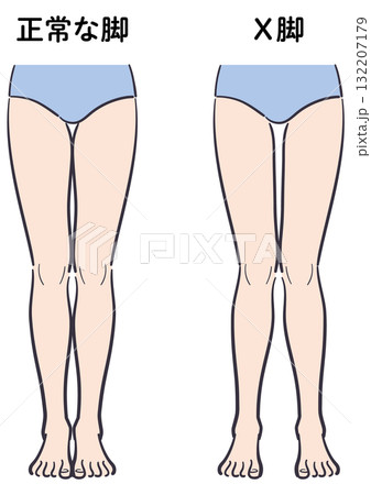 正常な脚とX脚の比較イラスト 132207179