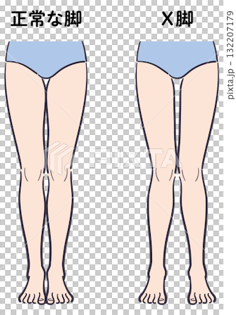 正常な脚とX脚の比較イラスト 132207179