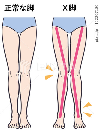 正常な脚とX脚の比較イラスト（補助線あり） 132207180
