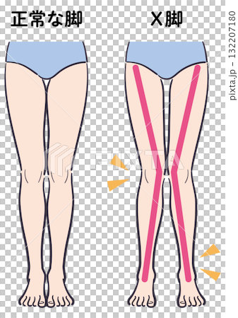 正常な脚とX脚の比較イラスト（補助線あり） 132207180