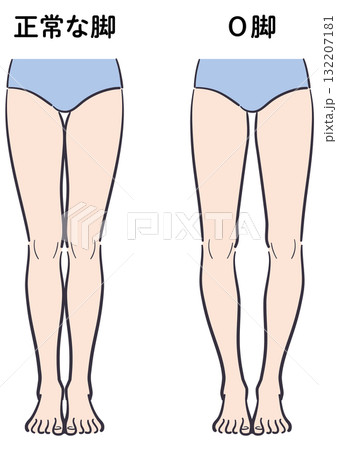 正常な脚とO脚の比較イラスト 132207181