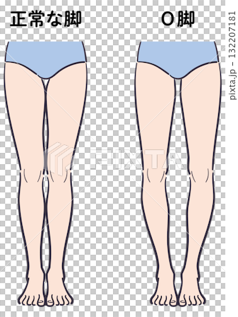正常な脚とO脚の比較イラスト 132207181
