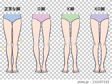 正常腿與羅圈腿、弓形腿和膝內翻腿的比較圖 132207183
