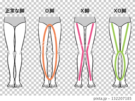 正常腿與 O 型腿、O 型腿、XO 型腿的比較圖(附輔助線/線圖類型) 正常腿與 O 型腿、O 型腿、XO 型腿的比較圖(附輔助線/線圖類型) 132207185