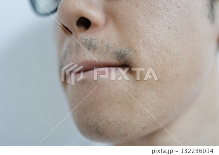 髭脱毛5回後の男性。口周りと顎のまだらに残った髭の状態。 髭脱毛5回後の男性。口周りと顎のまだらに残った髭の状態。 132236014