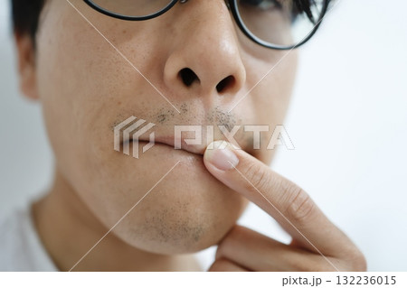 髭脱毛5回後の男性。口周りと顎のまだらに残った髭の状態。 132236015