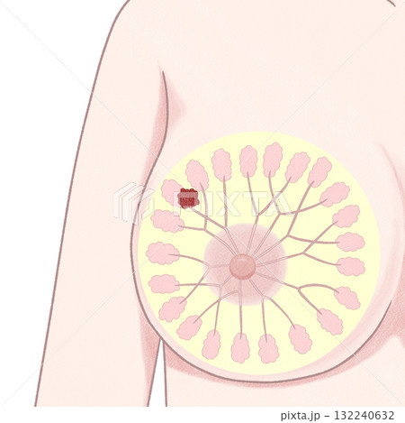 乳がん ステージⅠ(1期) わかりやすい図解イラスト 乳がん ステージⅠ(1期) わかりやすい図解イラスト 132240632