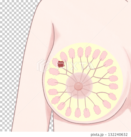 乳がん ステージⅠ(1期) わかりやすい図解イラスト 乳がん ステージⅠ(1期) わかりやすい図解イラスト 132240632