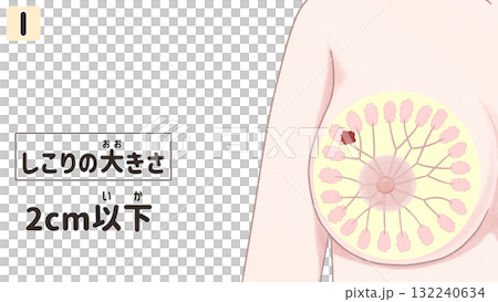 乳癌I期(第1期)簡單易懂的日文插圖 乳癌I期(第1期)簡單易懂的日文插圖 132240634