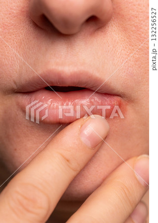 Close-up of a Painful Cold Sore on Lip Being Touched by Finger Close-up of a Painful Cold Sore on Lip Being Touched by Finger 132256527