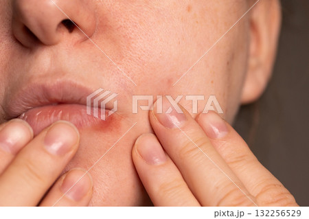 Close-up of Cold Sore Outbreak on the Lip of an Adult Close-up of Cold Sore Outbreak on the Lip of an Adult 132256529