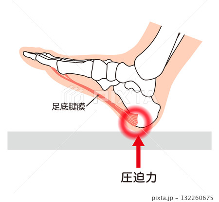 足底筋膜炎 足底筋膜 足底腱膜 足の筋肉 足底筋膜炎 足底筋膜 足底腱膜 足の筋肉 132260675